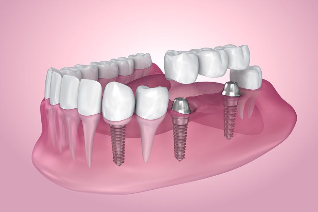 types of dental implants in Vienna Virginia