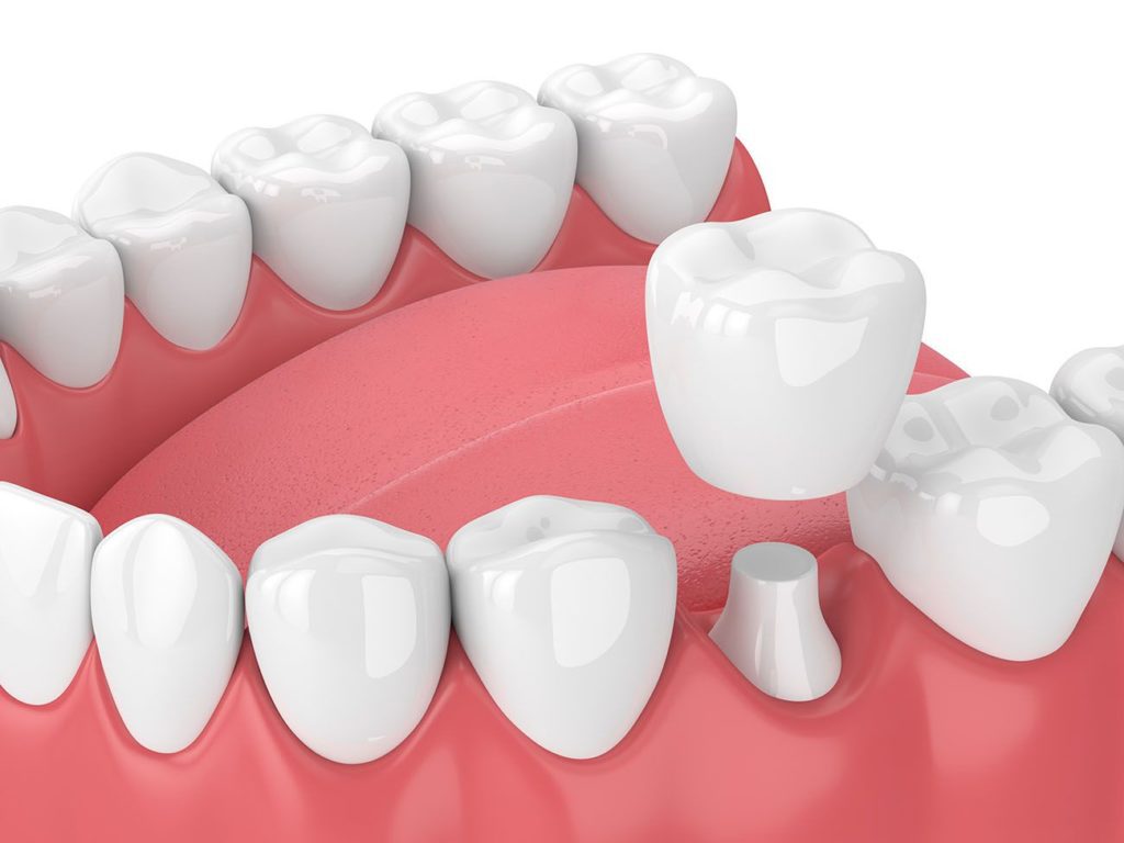 dental crown benefits Vienna Virginia