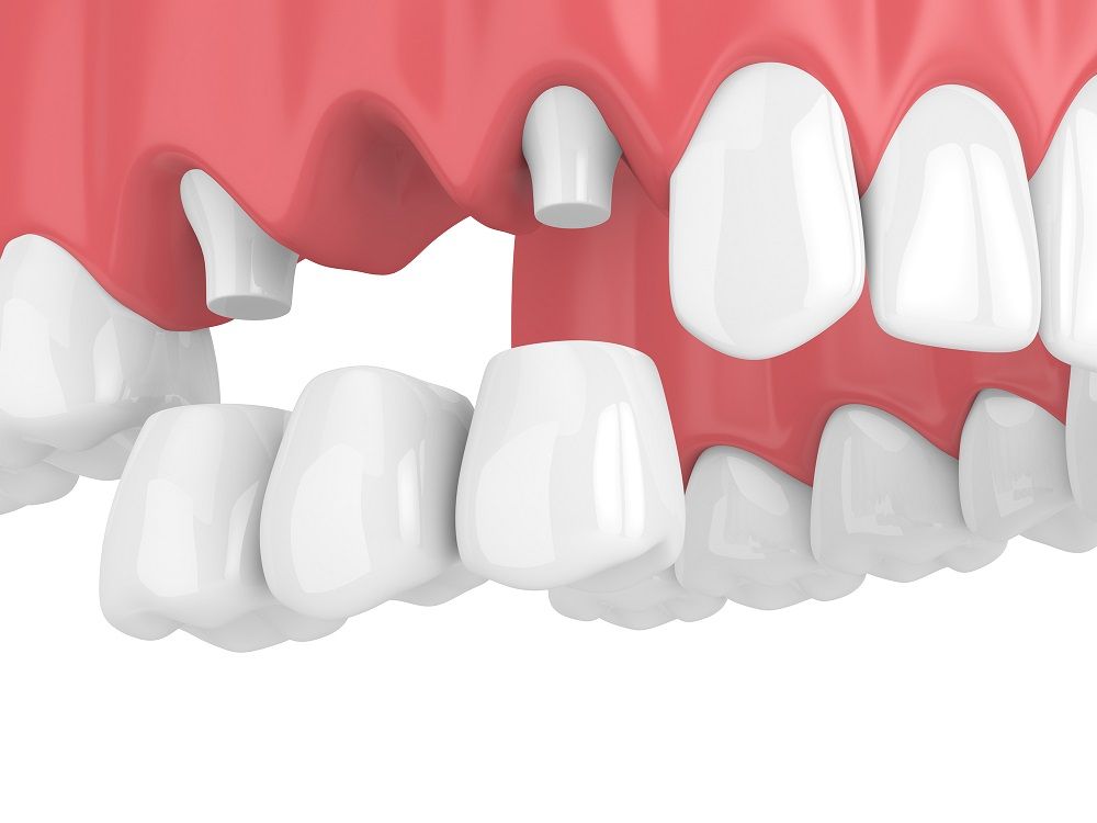 types of dental bridges