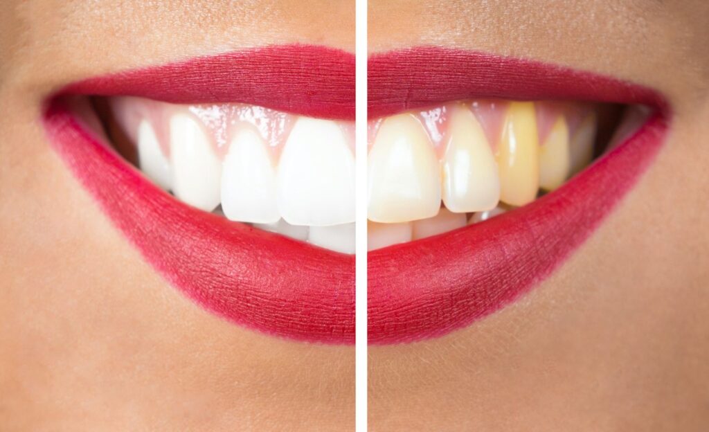 Meaning of Your Dental Discoloration
